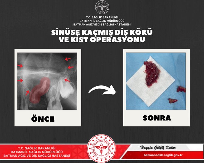 SİNÜSE KAÇAN DİŞ KÖKÜ VE KİST ÇIKARILDI