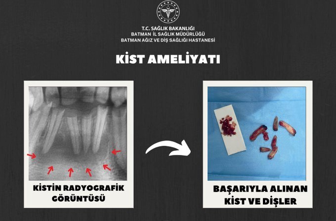 ADSH’DE BAŞARILI ÇENE CERRAHİSİ OPERASYONU