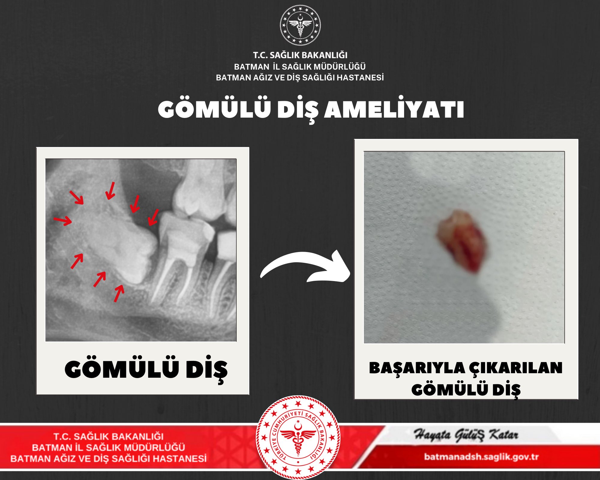 Ağız ve Diş Sağlığı Hastanesi’nde başarılı Çene Cerrahisi Operasyonu