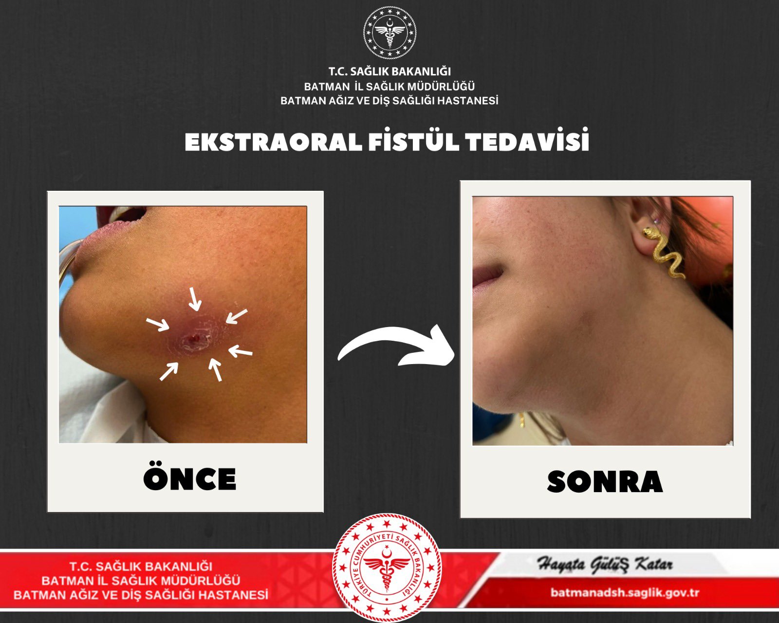 Batman Ağız ve Diş Sağlığı Hastanesinde Başarılı Tedavi