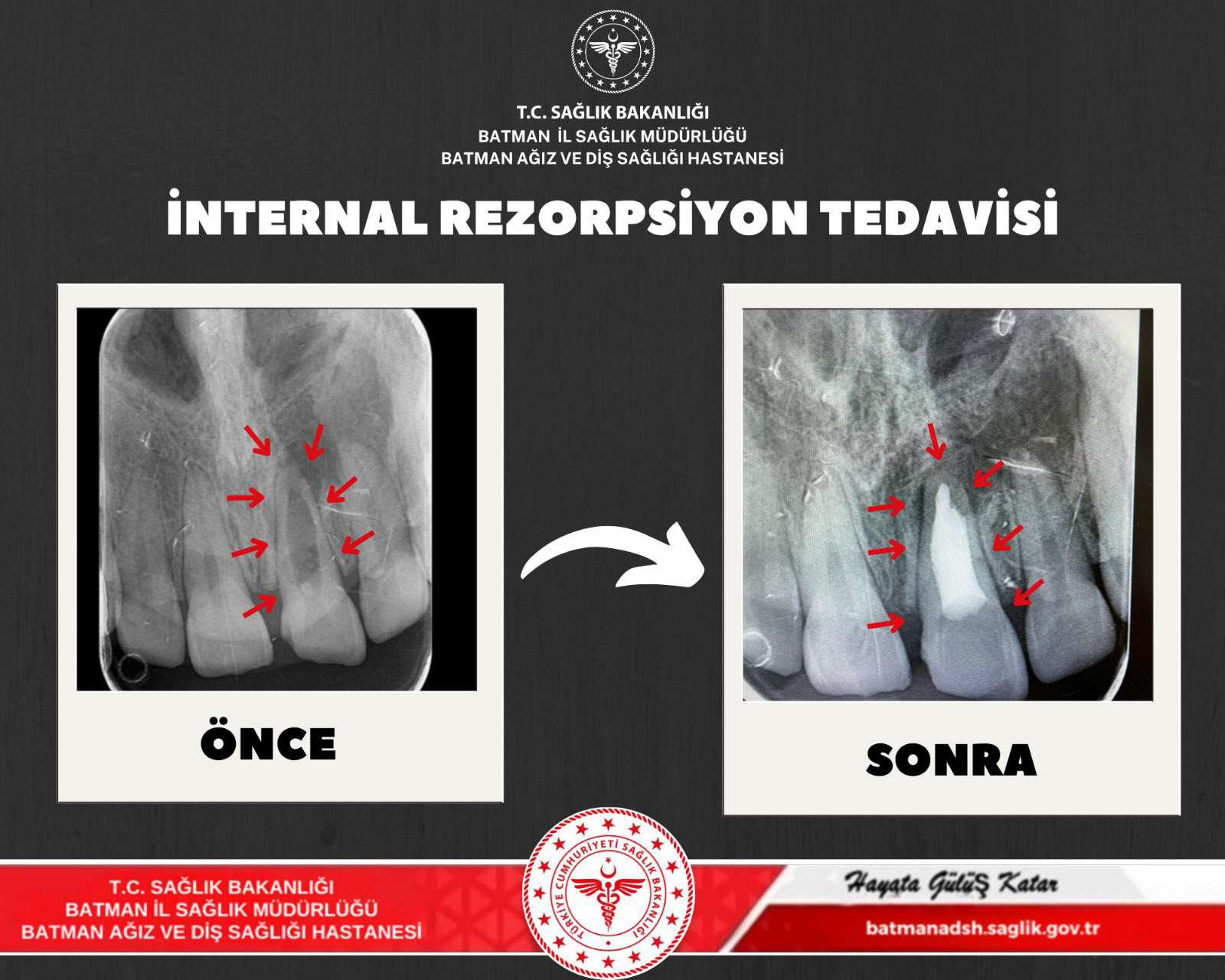 İnternal Rezorpsiyon Teşhisiyle Diş Kurtarıldı