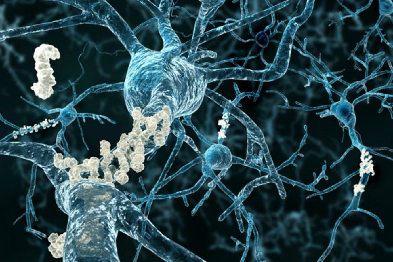 Alzheimer’a Erken Müdahalede Yeni Umut