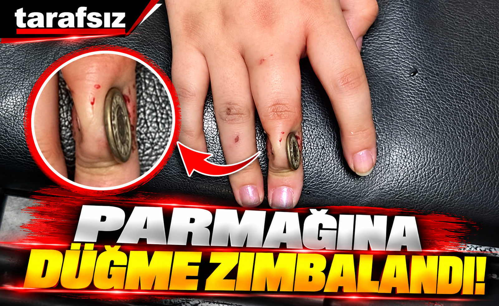 PARMAĞINA DÜĞME ZIMBALANDI!